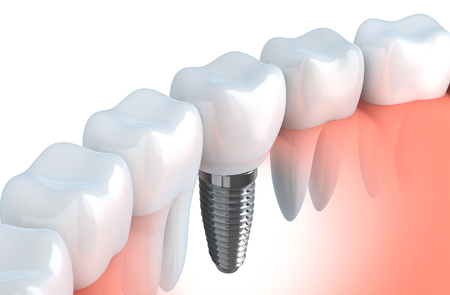 How Implant Dentistry in Blue Earth MN Improves Even the Most Damaged Smiles