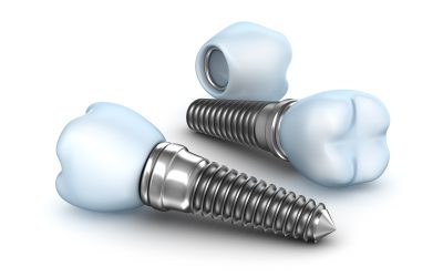 Why Do You Need Dental Implants in Willmar, MN?