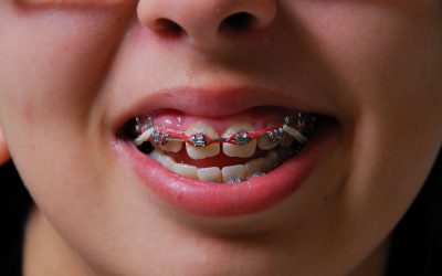 The Benefits Of Invisalign Aligners In Medina OH