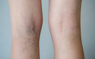 Non-Surgical Laser Treatments And Sclerotherapy Are Used To Treat Spider Veins